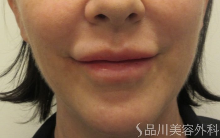 症例NO.72274のAFTER写真