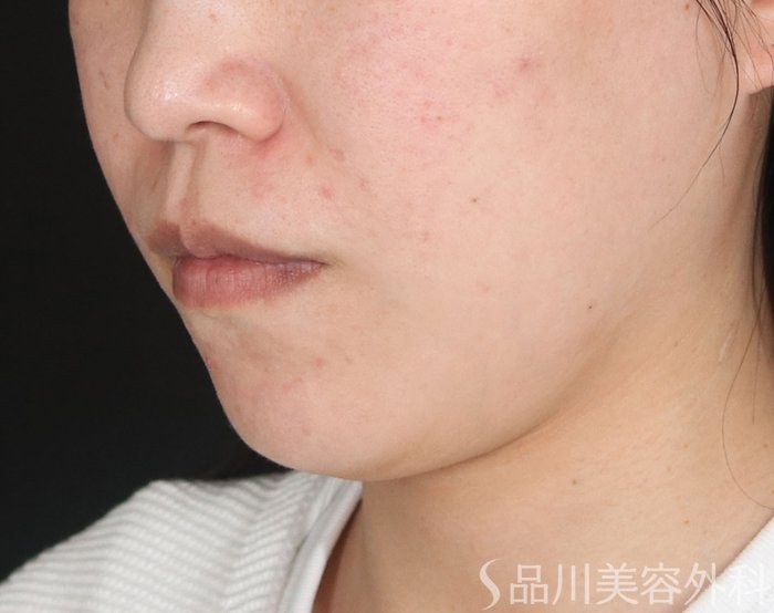 症例NO.72262のBEFORE写真