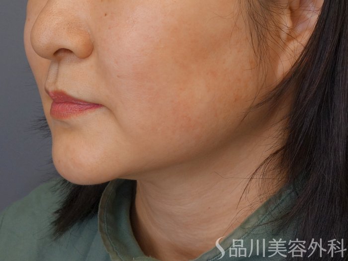 症例NO.70273のBEFORE写真