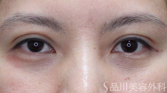 症例NO.71037のAFTER写真
