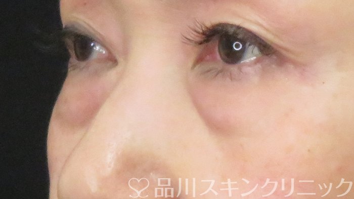 症例NO.71899のBEFORE写真