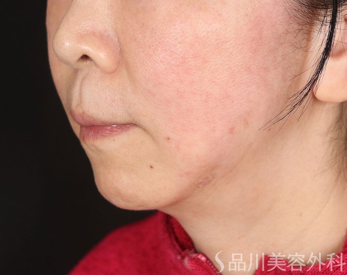 症例NO.73186のAFTER写真