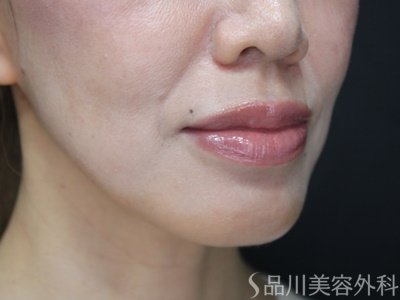 症例NO.75067のBEFORE写真