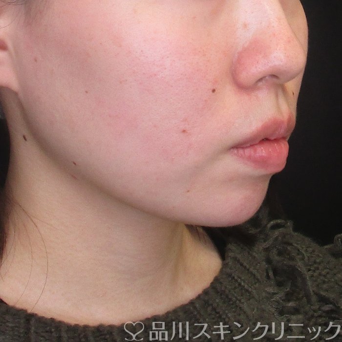 症例NO.72710のAFTER写真