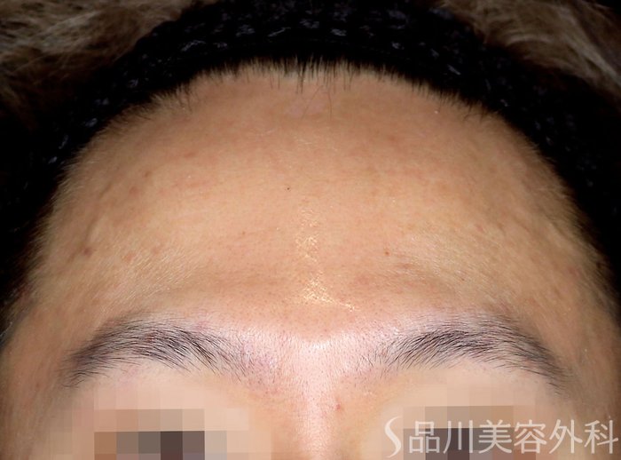 症例NO.67404のAFTER写真