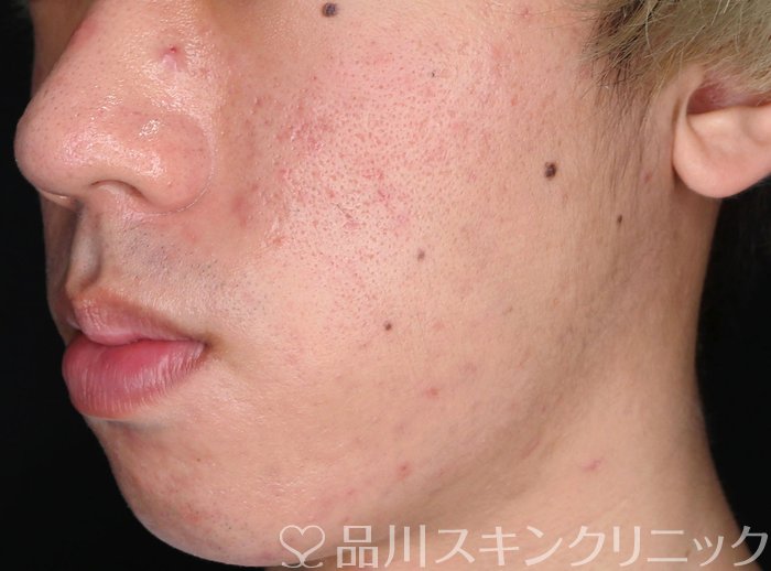 症例NO.64170のBEFORE写真