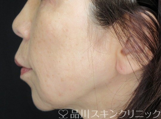 症例NO.67680のAFTER写真