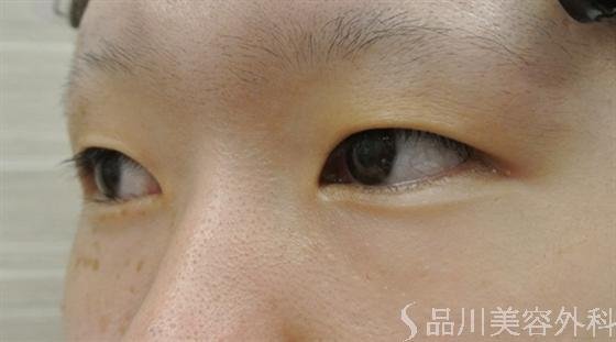 症例NO.14604のBEFORE写真