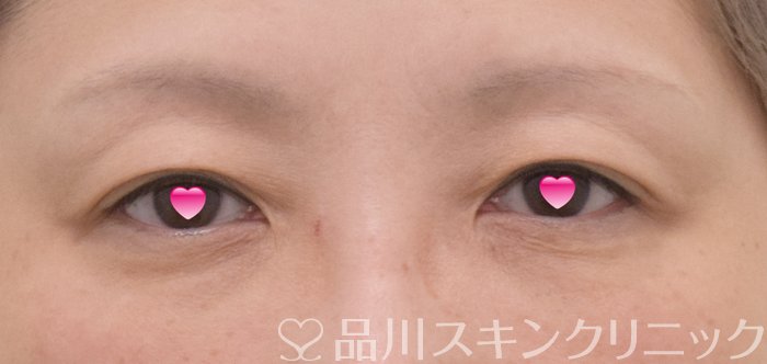 症例NO.74272のBEFORE写真