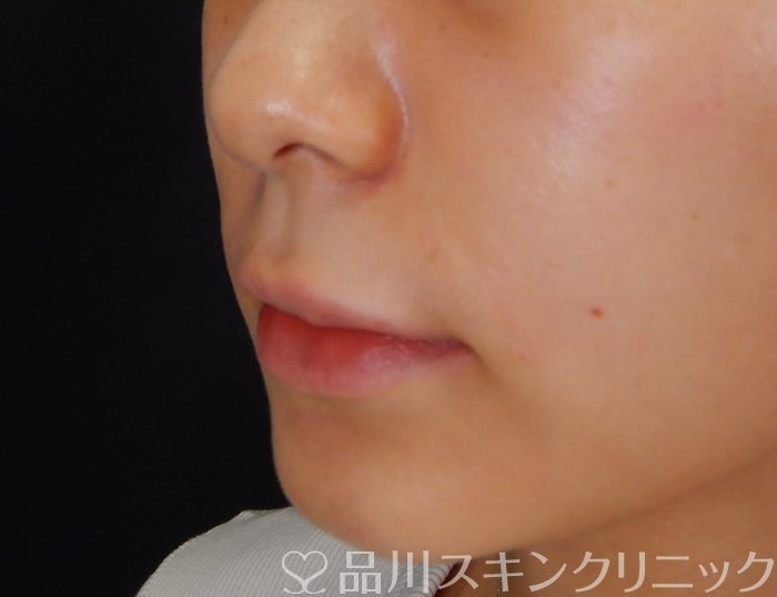 症例NO.66676のAFTER写真
