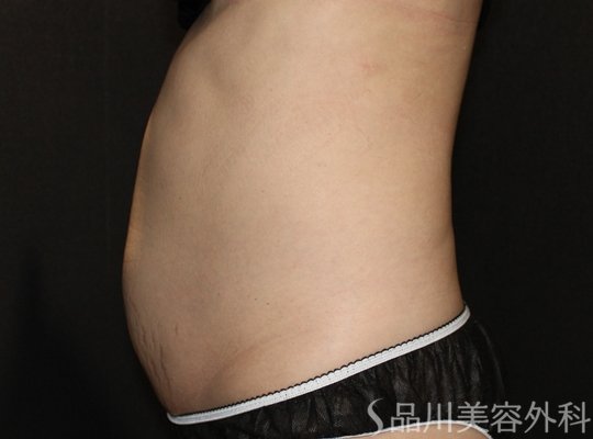 症例NO.72604のAFTER写真