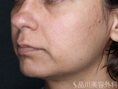症例NO.71539のBEFORE写真