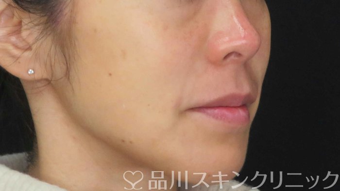 症例NO.71223のAFTER写真