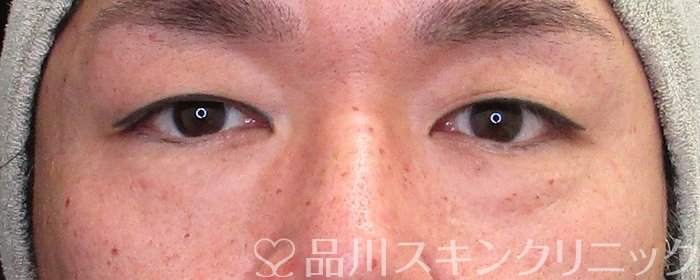 症例NO.64097のBEFORE写真