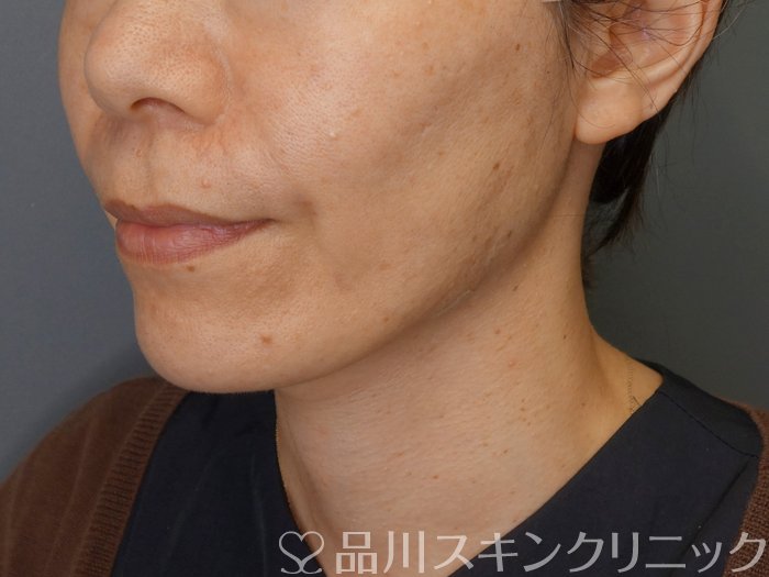 症例NO.71381のAFTER写真