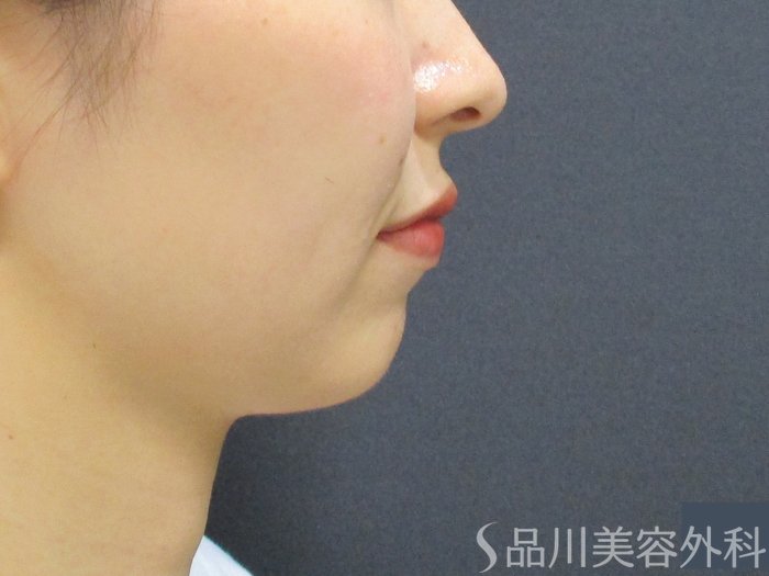 症例NO.74820のBEFORE写真