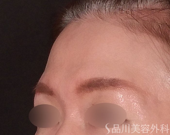 症例NO.70526のBEFORE写真