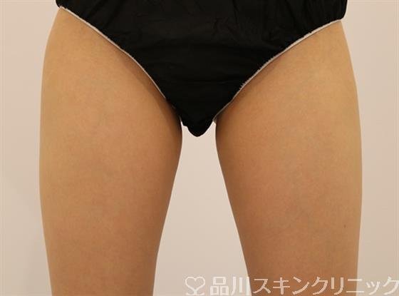 症例NO.41071のAFTER写真