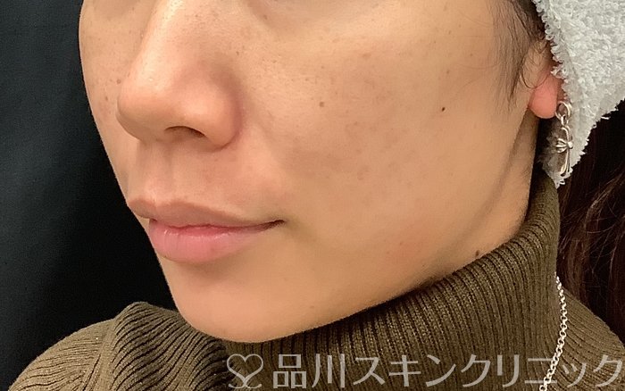 症例NO.67961のAFTER写真