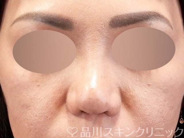 症例NO.67918のAFTER写真