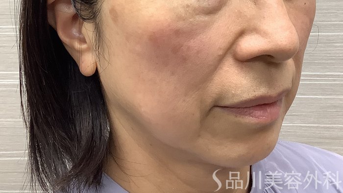症例NO.62222のBEFORE写真