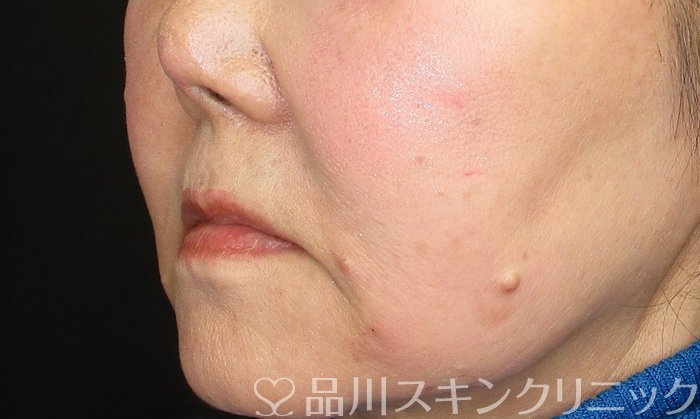 症例NO.72745のAFTER写真