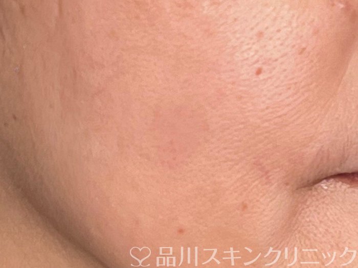 症例NO.65711のAFTER写真