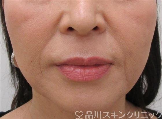 症例NO.39792のBEFORE写真