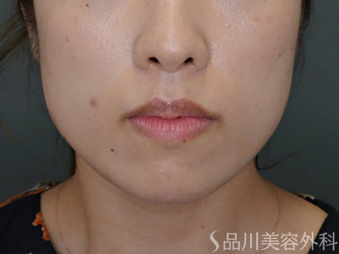 症例NO.71773のBEFORE写真