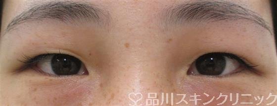 症例NO.26965のBEFORE写真