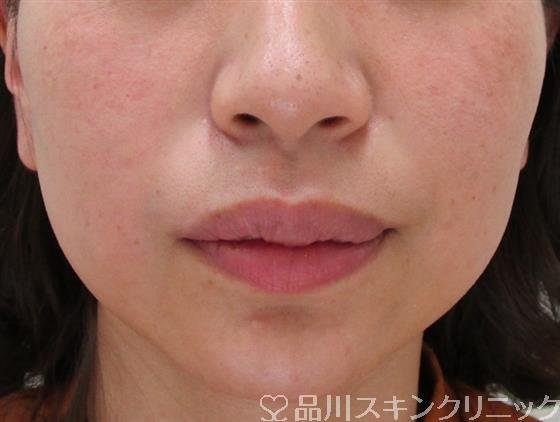 症例NO.31860のAFTER写真
