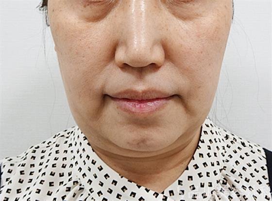 症例NO.61740のBEFORE写真