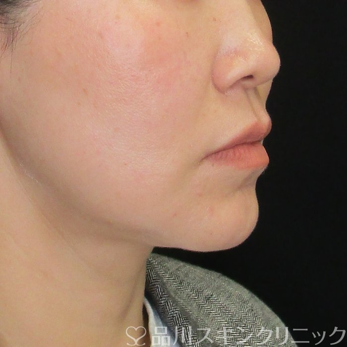 症例NO.74374のAFTER写真