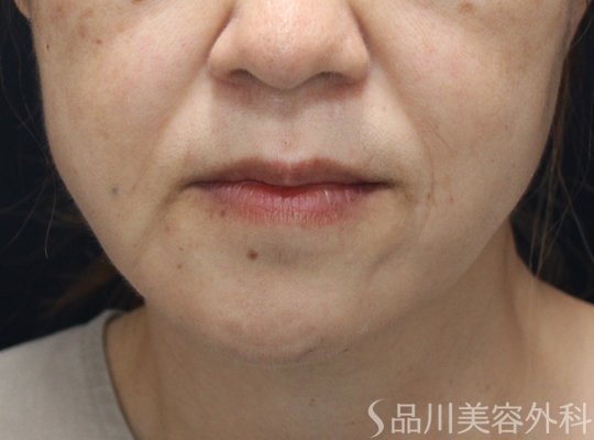 症例NO.74431のBEFORE写真