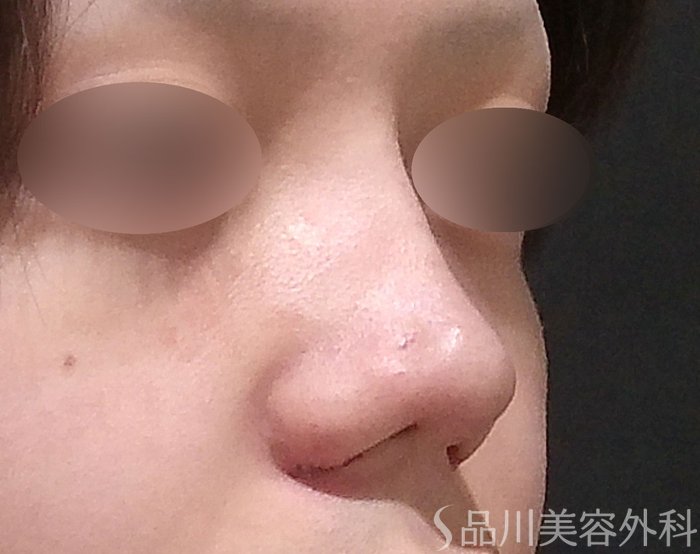 症例NO.71424のAFTER写真