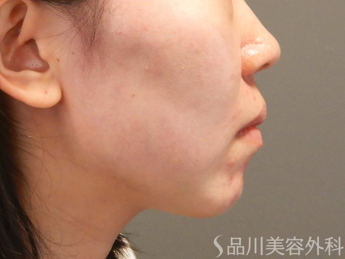 症例NO.70852のAFTER写真