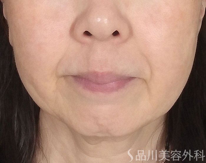 症例NO.69741のBEFORE写真