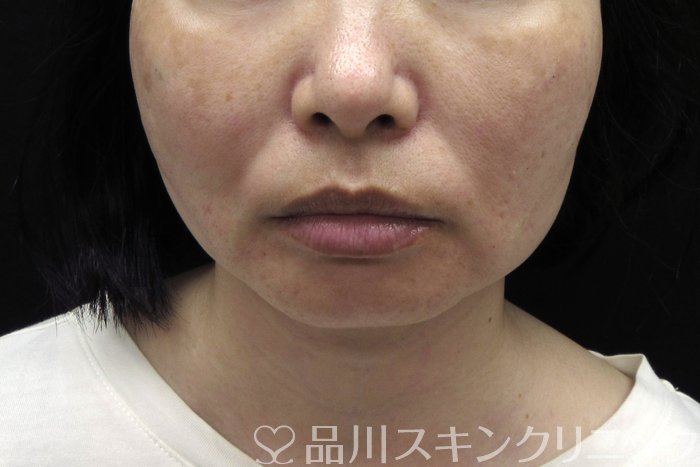 症例NO.74421のAFTER写真