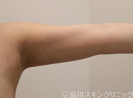 症例NO.46544のAFTER写真