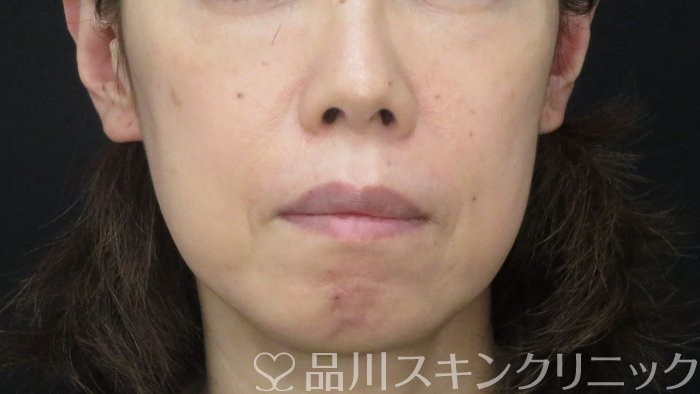 症例NO.72502のBEFORE写真