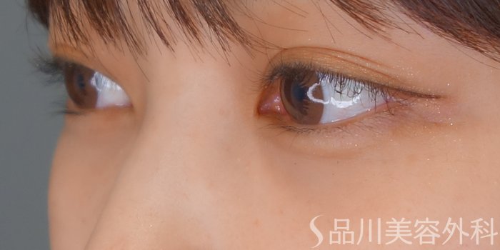 症例NO.69751のAFTER写真