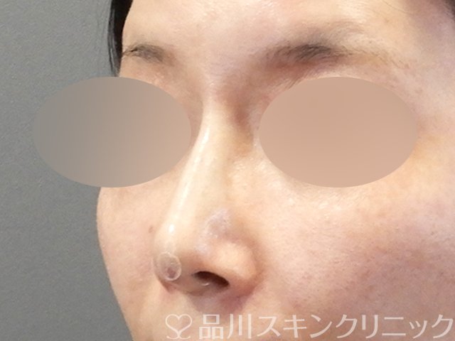 症例NO.67081のAFTER写真