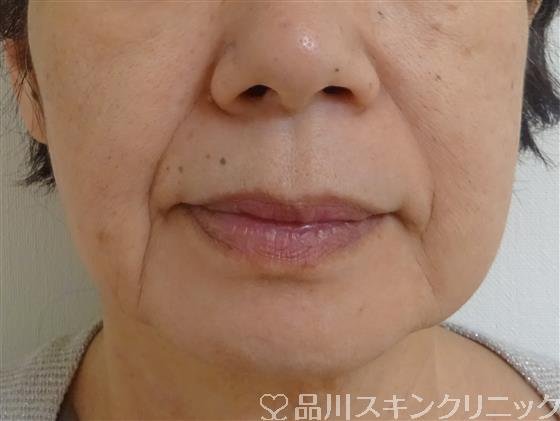 症例NO.38460のBEFORE写真