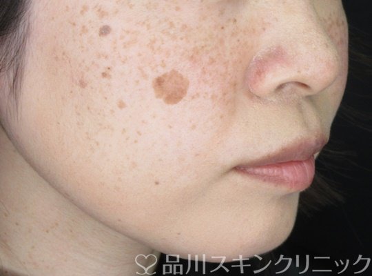 症例NO.70043のBEFORE写真