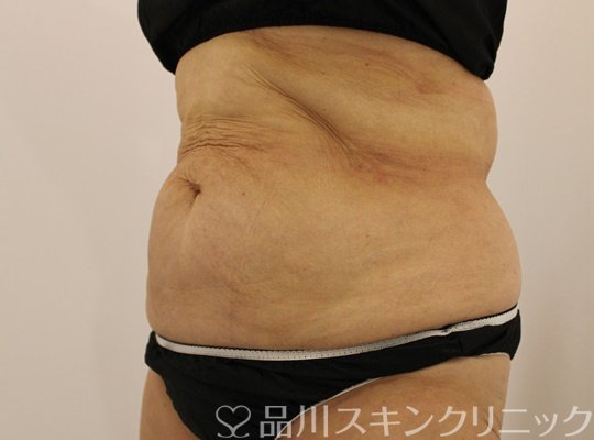 症例NO.73961のAFTER写真