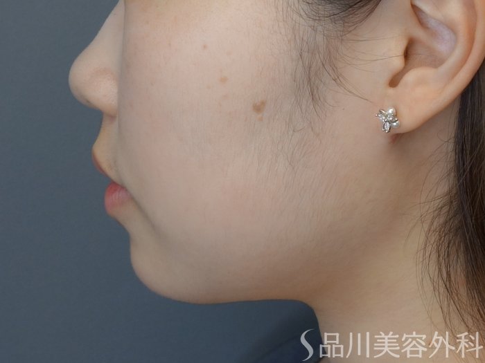 症例NO.73387のAFTER写真