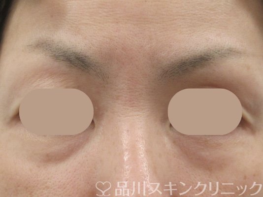 症例NO.69301のBEFORE写真