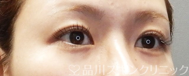 症例NO.72991のBEFORE写真