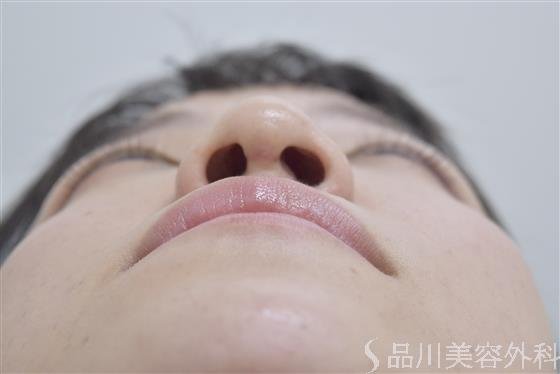 症例NO.51781のAFTER写真