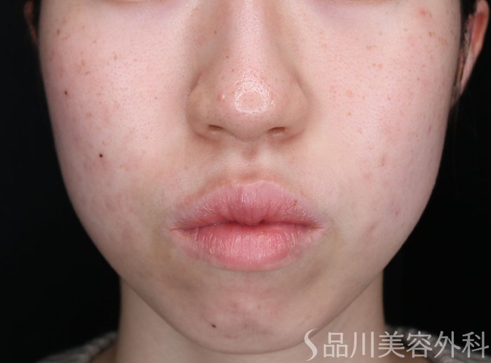 症例NO.73511のAFTER写真